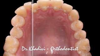 ارتودنسی ثابت دو فک بدون کشیدن دندان.متخصص ارتودنسی دکتر علیرضا خدیوی