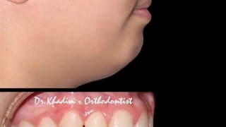 ارتودنسی دو مرحله ای.متخصص ارتودنسی دکترعلیرضا خدیوی