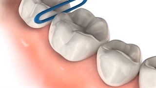 سپریتور ارتودنسی.متخصص ارتودنسی دکترعلیرضا خدیوی