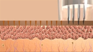 میکرونیدلینگ پوست صورت جراحی گوش