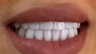 18 واحد لمینت سرامیکی ایمکس