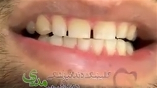 16 واحد ونیر کامپوزیت فک بالا و پایین