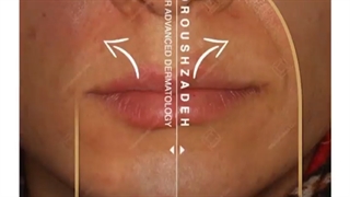 تزریق ژل خط خنده بدون درد