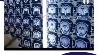 صرع لوب تمپورال