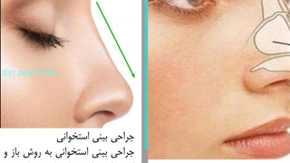 جراحی زیبایی بینی و انواع آن