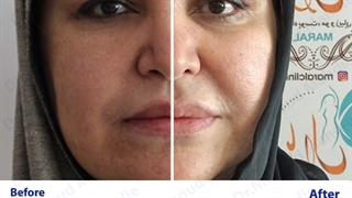 دکتر مهدیه متخصص بلفاروپلاستی