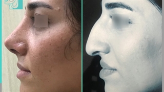 انجام جراحی زیبایی بینی برای زیباجو عزیز توسط دکتر پژمان سرشارزاده