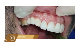 آیا با وجود روکش ایمپلنت می توان کارهای زیبایی و سرامیک انجام داد؟