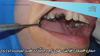 فیلم درمان همزمان افزایش طول تاج و جایگذاری فوری ایمپلنت دو دندان کنار هم.