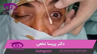 خارج کردن تومور بزرگ حدقه از ناحیه داخلی چشم