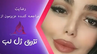 تزریق ژل لب نمونه کار دکتر حمید ارونقی
