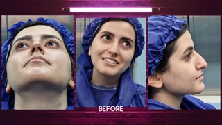 قبل و بعد از عمل بینی در اهواز