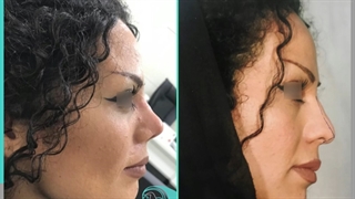 انجام جراحی زیبایی بینی برای زیباجو عزیز توسط دکتر پژمان سرشارزاده
