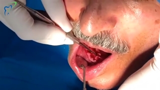 جراحی ایمپلنت دندان