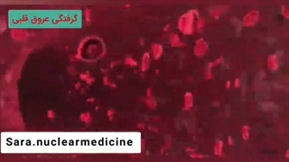 همه چیز درباره گرفتگی عروق