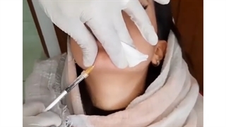 فیلم واقعی تززیق همزمان ژل لب و چانه
