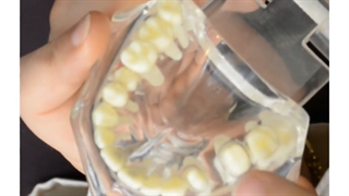 انواع بریج دندانی