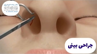 انیمیشن بسیار واقعی از جراحی بینی