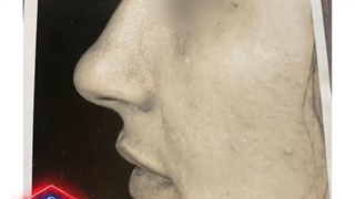 نمونه کار جراحی بینی دکتر احمد دانشی