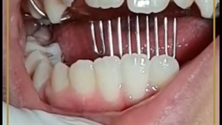 ارتودنسی متحرک