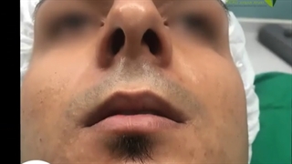 جراحی زیبایی بینی