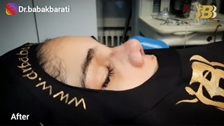 جراحی زیبایی بینی گوشتی دکتر بابک براتی