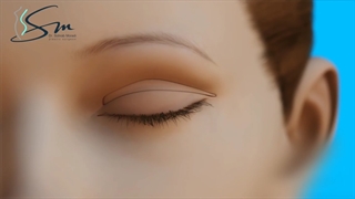 انیمیشن جراحی زیبایی پلک