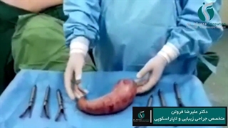 جراحی اسلیو معده