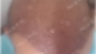 کاشت ابرو و مو به صورت طبیعی