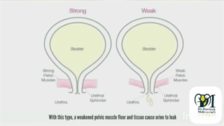 بی اختیاری ادرار