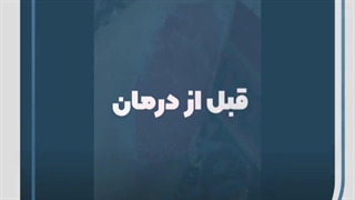 درمان زخم سوختگی توسط کلینیک زخم نور