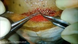 فیلم از روش کاشت مو