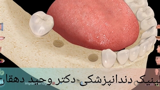 دکتر وحید  دهقان : بریج بر پایه ایمپلنت