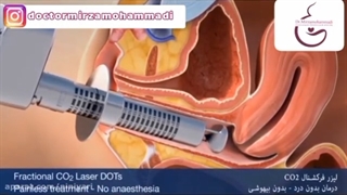 جوانسازی ناحیه تناسلی خانم ها