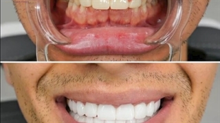 فیلم واقعی لمینت دندان تزریق ژل