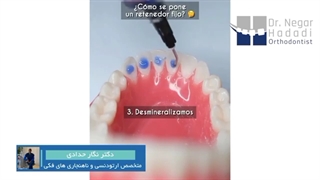 مراحل گذاشتن نگهدارنده ثابت