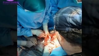 جراحی سرطان رحم و دهانه رحم