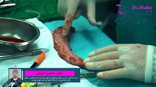 وسایل عمل جراحی چاقی که احتمالا اسمشون رو هم نشنیدی... |  دکتر شاهین جمیلی