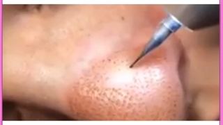 کاربرد ،مزایا و نتایج حیرت‌ آور پلاسماجت بررسی لک صورت