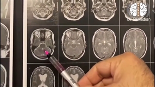 عمل جراحی ونتریکولوستومی آندوسکوپیک بطن سوم(ETV) جهت درمان هیدروسفالی