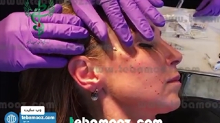 نخ کاگ چیست و چه تاثیری روی درمان افتادگی پوست دارد؟