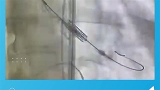 تعویض دریچه آئورت به روش غیر جراحی