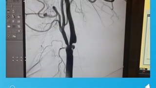 آنژیوپلاستی تنگی شریان کاروتید (رگ اصلی خونرسانی کننده به مغز)
