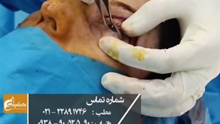 جراحی پف پلک پایین