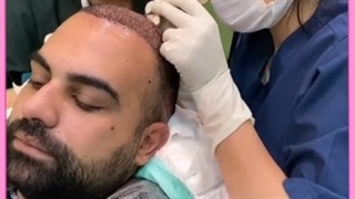 کاشت مو به روش BHT
