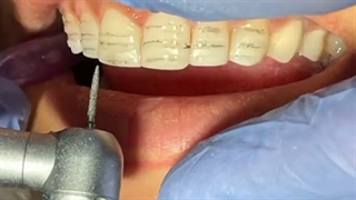 پرسلن لامینیت ونیر