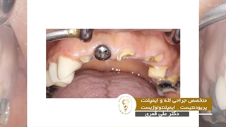 بازسازی فک بالا با کاشت 8 ایمپلنت هم زمان