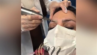 پاک کردن تتو ابرو ( کلینیک زیبایی استار بیوتی )