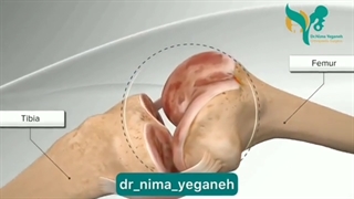 انیمیشن تعویض مفصل زانو