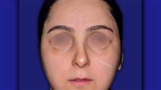 قبل و بعد عمل رینوپلاستی یا جراحی زیبایی بینی | دکتر خوروش